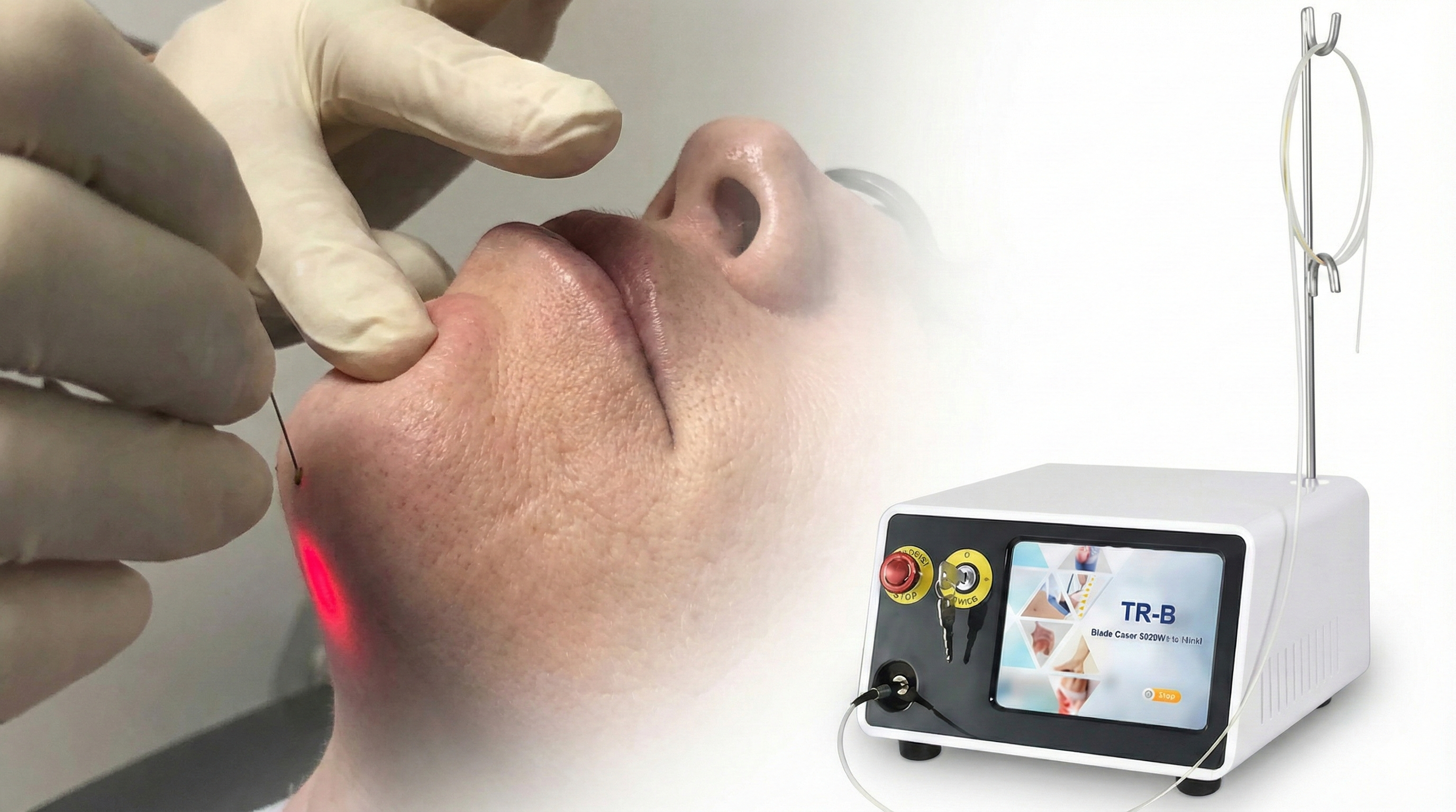 Endolifting láser - imagen 2